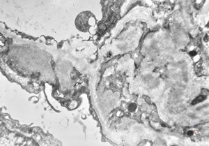 M,53y. | type III membranoproliferative glomerulonephritis M,53y. | type III membranoproliferative glomerulonephritis